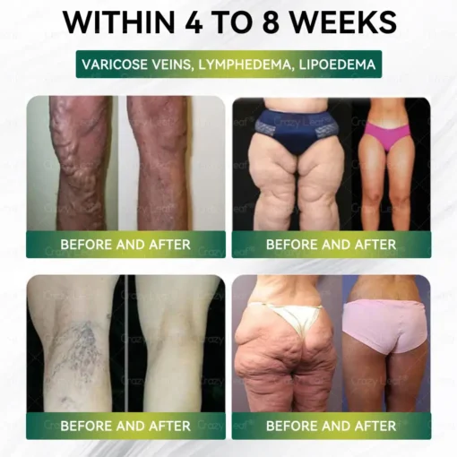 𝐂𝐫𝐚𝐳𝐲𝐋𝐞𝐚𝐟® 𝐆𝐋𝐏-𝟏 𝐖𝐞𝐢𝐠𝐡𝐭 𝐋𝐨𝐬𝐬 𝐃𝐫𝐨𝐩𝐬,𝐒𝐮𝐩𝐩𝐨𝐫𝐭𝐬
